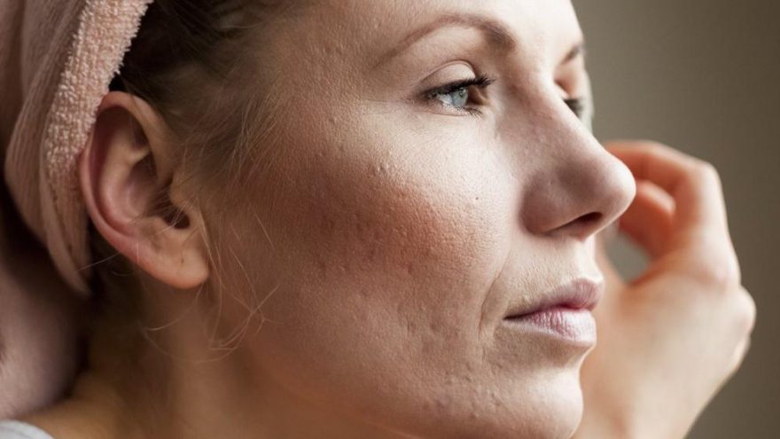 Sivilce temizleyen maske tarifleri…