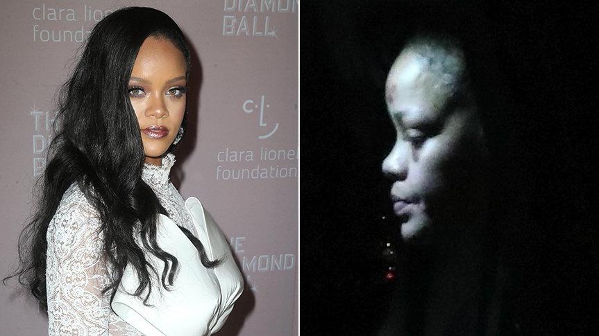 Rihanna’nın yüzündeki morluklar hayranlarını korkuttu