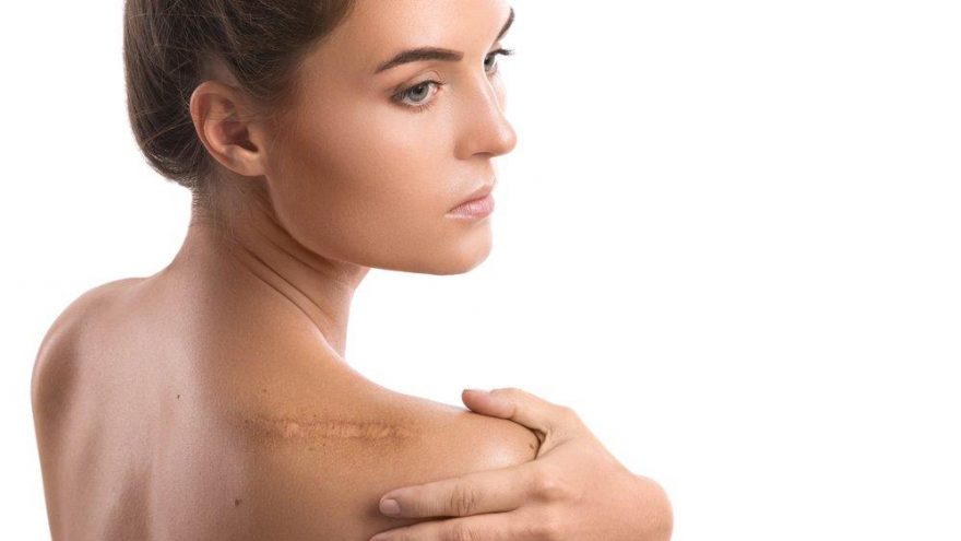 Yara Izlerini Azaltan Dogal Tedavi Yontemleri Nelerdir Guzellik Haberleri