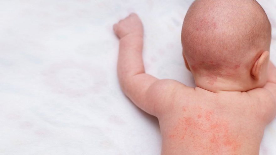 onlemek taki atletik bebeklerde alerji kasintisina ne iyi gelir canakkalebattalbey com
