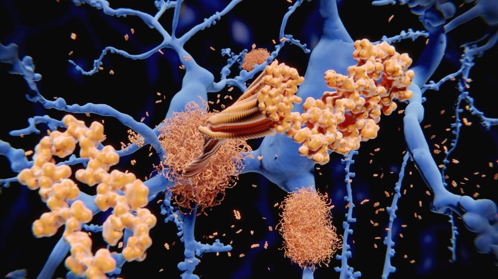 Alzheimer hastalığındaki keşif, yeni tedavi yöntemleri için umut oldu