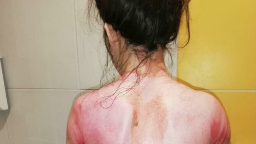Eşinin üzerine kaynar su döktüğü Rukiye A.: Ölmek istemiyorum
