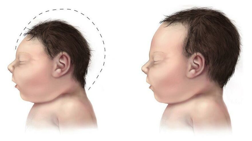 Zika virüsü nedir?