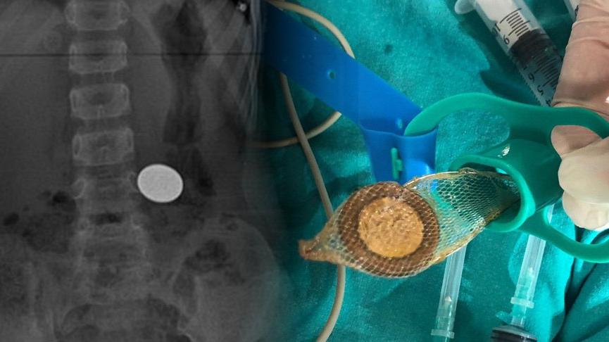 5 yaşındaki çocuğun yuttuğu 50 kuruş, ameliyatla çıkarıldı