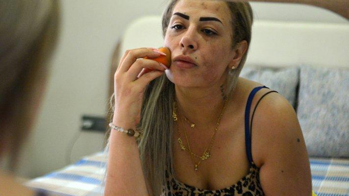 Güzellik merkezinde peeling yaptırdı, yüzü yandı