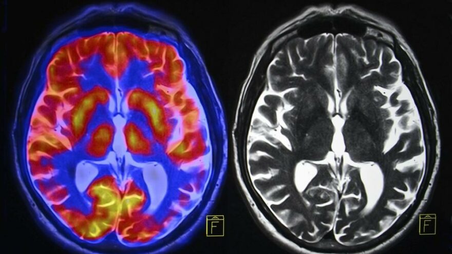 Alzheimer’la mücadelede müthiş başarı: Yeni teknoloji yüzde 99 fark ediyor